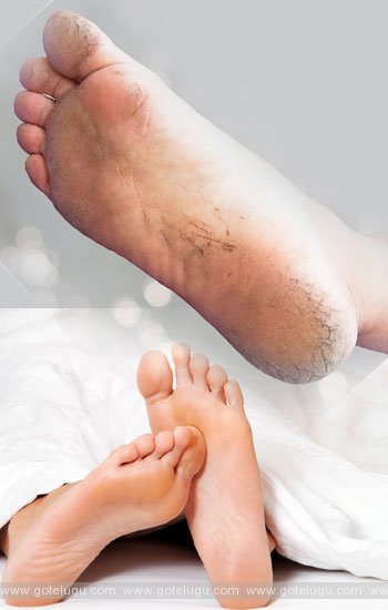 home remedies for feet cracks