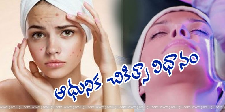 Acne - Modern Therapy.!